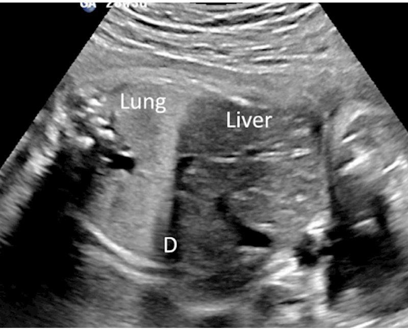 Hypoechoic liver in a fetus with trisomy 21 but without transient abnormal myelopoiesis at birth
